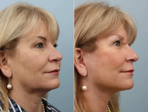 Seurico™ Facial Massager - Red Light Therapy Facial Sculpting & Facial Contouring Device