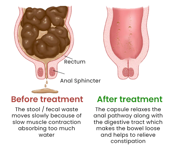 I-Vflux™ Constipation Relief Capsule