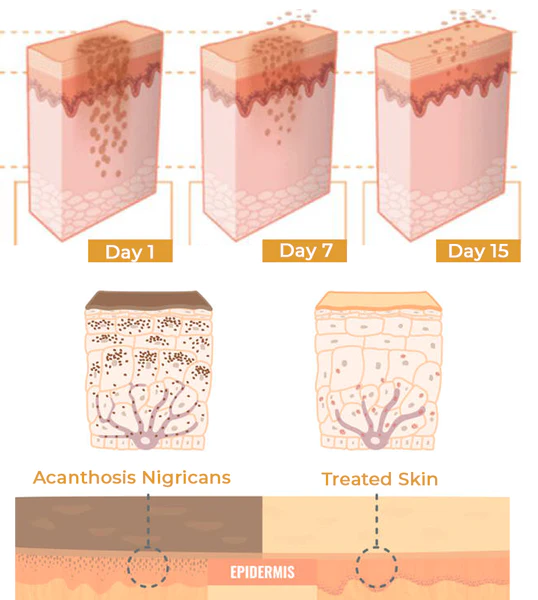 ATTDX ClearSkin Acanthosis Nigricans Therapy Cream