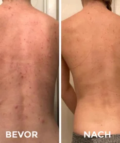 Fivfivgo™ Spray zur Behandlung von Akne am Rücken