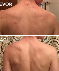 Fivfivgo™ Spray zur Behandlung von Akne am Rücken