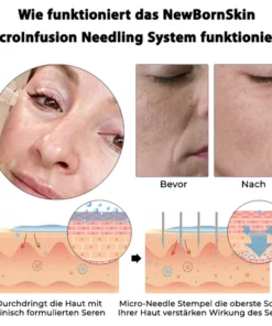 نظام الإبر MicroInfusion من ATTDX SkinRevive