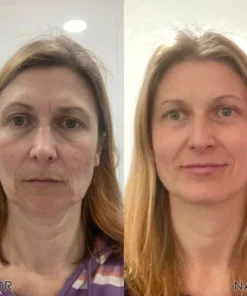 نظام الإبر MicroInfusion من ATTDX SkinRevive