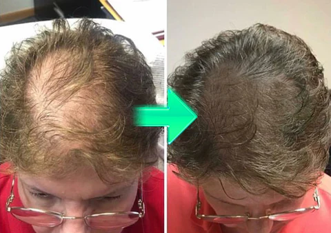 Biancat™ FolliHerb Hair Growth Spray