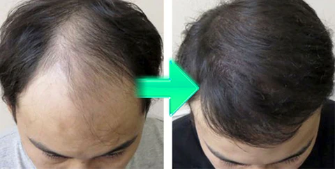 Biancat™ FolliHerb Hair Growth Spray