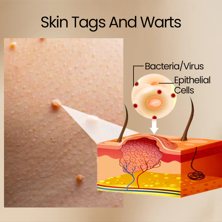 Ceoerty™ Bee Venom ClearSkin Wart eta etiketak kentzeko tratamendu-spray