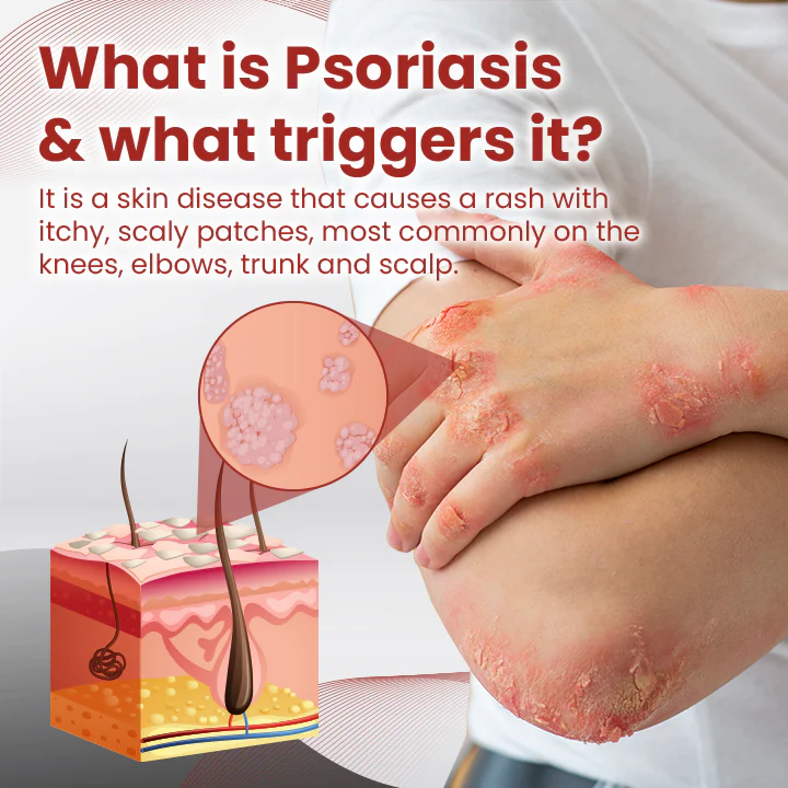 Ceoerty™ PsoriaCare tratamendu spray
