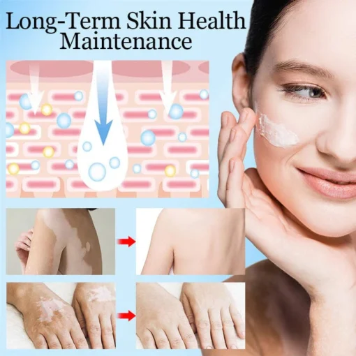 Krim Penghilang Vitiligo Ceoerty™