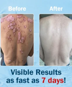 Alternative view of Cvreoz™ Krem leczący wieloobjawową łuszczycę z jadem pszczelim