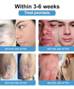 Cvreoz™ Krem leczący wieloobjawową łuszczycę z jadem pszczelim