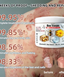 Cvreoz™ Krem leczący wieloobjawową łuszczycę z jadem pszczelim