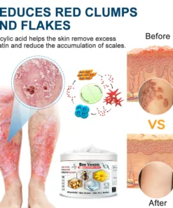 Cvreoz™ Krem leczący wieloobjawową łuszczycę z jadem pszczelim