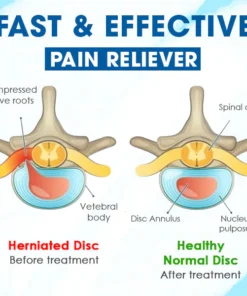 جهاز EMSHealth™ لعلاج الأقراص المنفتقة