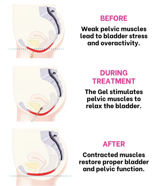 FemiPoise™ Bladder Control Gel 