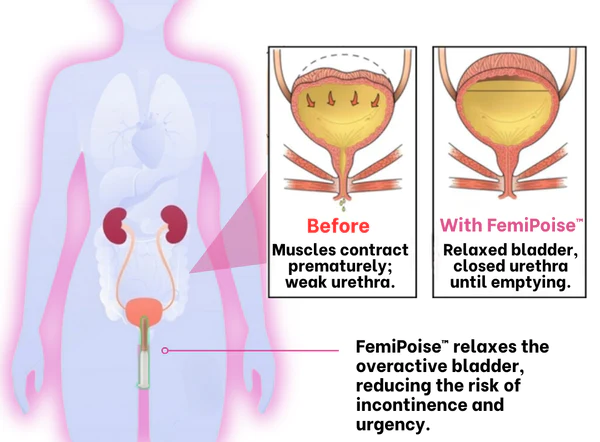 FemiPoise™ Maskurraren Kontrol Gela
