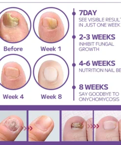 Fivfivgo™ Anti-Pilz-Nagelspray