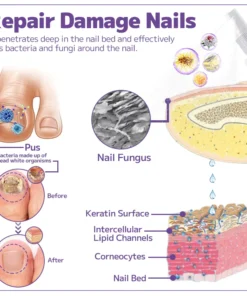 Fivfivgo™ Anti-Pilz-Nagelspray