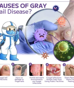 Fivfivgo™ Anti-Pilz-Nagelspray