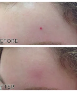 Fivfivgo™ Petechien Entfernungscreme