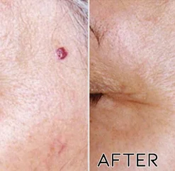 Fivfivgo™ Petechien Entfernungscreme