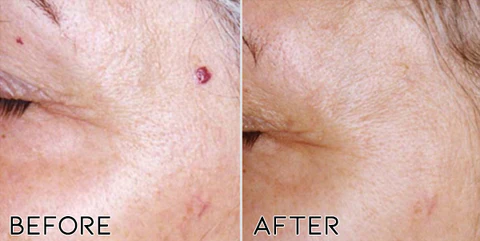 Fivfivgo™ Petechien Entfernungscreme