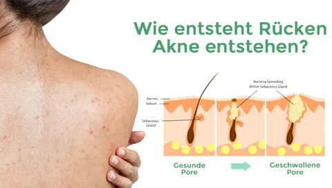 Fivfivgo™ Spray zur Behandlung von Akne am Rücken