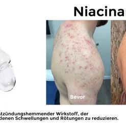 Fivfivgo™ Spray zur Behandlung von Akne am Rücken