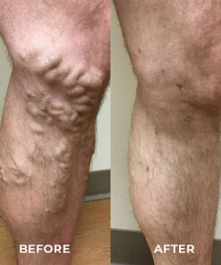 Fivfivgo™ VeinCare Varizen Behandlungsspray