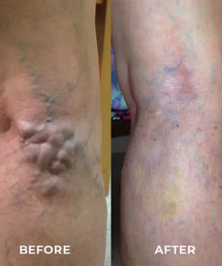 Fivfivgo™ VeinCare Varizen Behandlungsspray