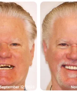 Furzero™ Propolis Oral Instant Treatment Spray