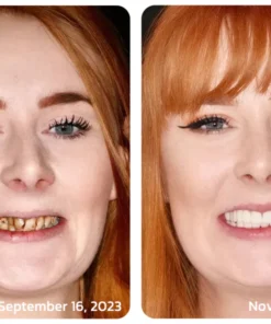 Furzero™ Propolis Oral Instant Treatment Spray