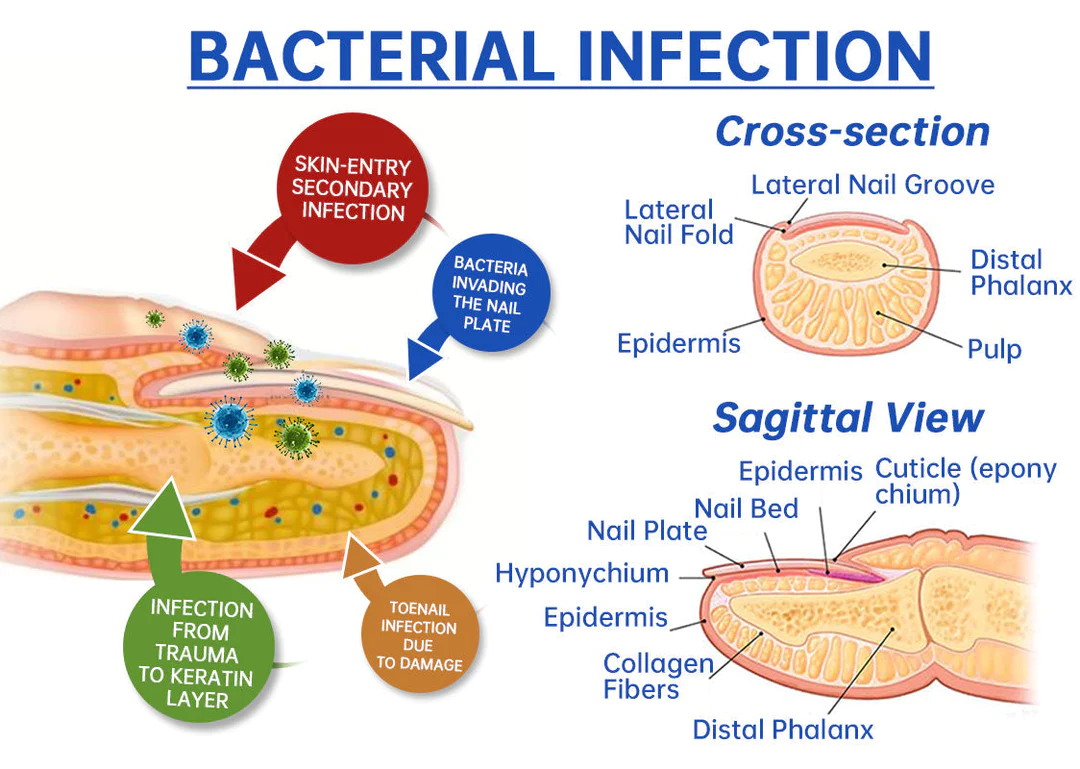 Furzero™ PureNail Fungus Laser Therapy Device Max - Image 3
