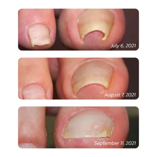 GFOUK™ German ToenailHeal Paronychia Relief Patch