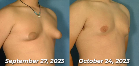 زيت التدفئة GFOUK™ MenTherm Bee Venom Gynecomastia