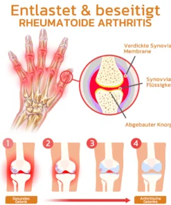 GFOUK™ Bienengift Gelenk- und Knochentherapie Spray