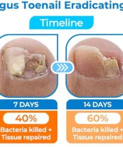 GFOUK™ Fungus Toenail Eradicating Laser Device