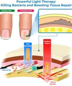 GFOUK™ Fungus Toenail Eradicating Laser Device