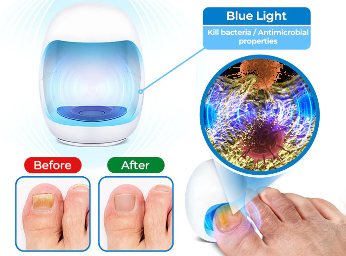 GFOUK™ Fungus Toenail Eradicating Laser Device