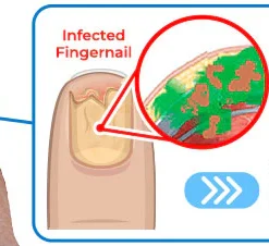 GFOUK™ Fungus Toenail Eradicating Laser Device