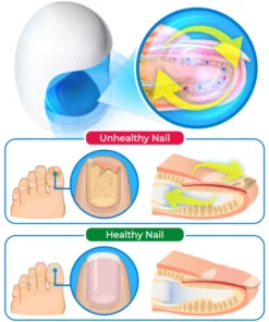 GFOUK™ Fungus Toenail Eradicating Laser Device