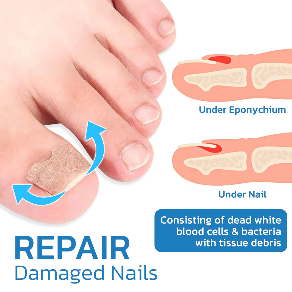 GFOUK™ German ToenailHeal Paronychia Relief Patch