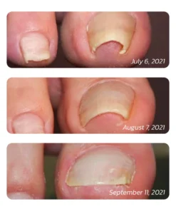 GFOUK™ German ToenailHeal Paronychia Relief Patch