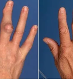 GoutAid™ Instant Relieving Spray