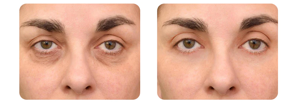 HIMEYE™ PEPTIDE Begietako sueroa