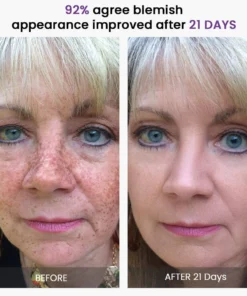 KISSHI™ Rapid Relief Blemish Treatment