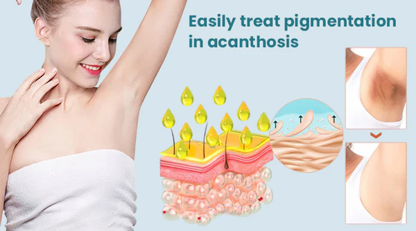 LIMETOW™ Acanthosis Nigricans -hoitovoide