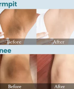 LIMETOW™ Acanthosis Nigricans Therapy Cream