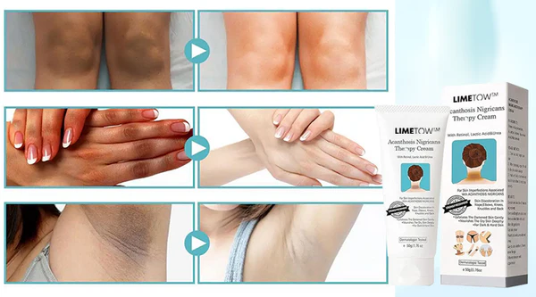 LIMETOW™ Acanthosis Nigricans Therapy Cream

