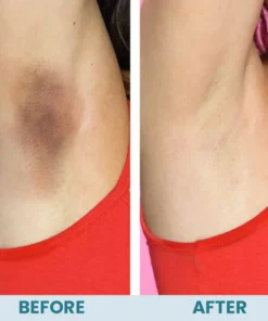 LIMETOW™ Acanthosis Nigricans Therapy Cream