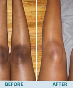 LIMETOW™ Acanthosis Nigricans Therapy Cream